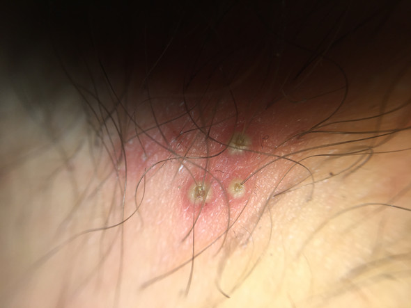 Pickel Im Intimbereich Oder Nicht Arzt Pickel Im Intimbereich Oder Nicht Arzt