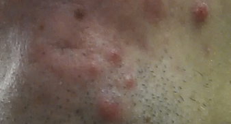 - (Gesundheit, Pickel, Gesicht)