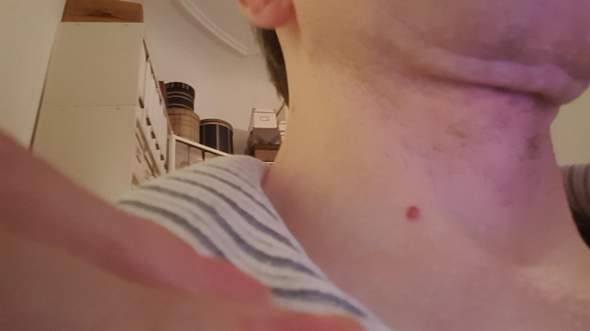 Pickel Mit Schwarzen Punkt Am Hals Was Ist Das Hautarzt Pickel Mit Schwarzen Punkt Am Hals Was Ist Das Hautarzt