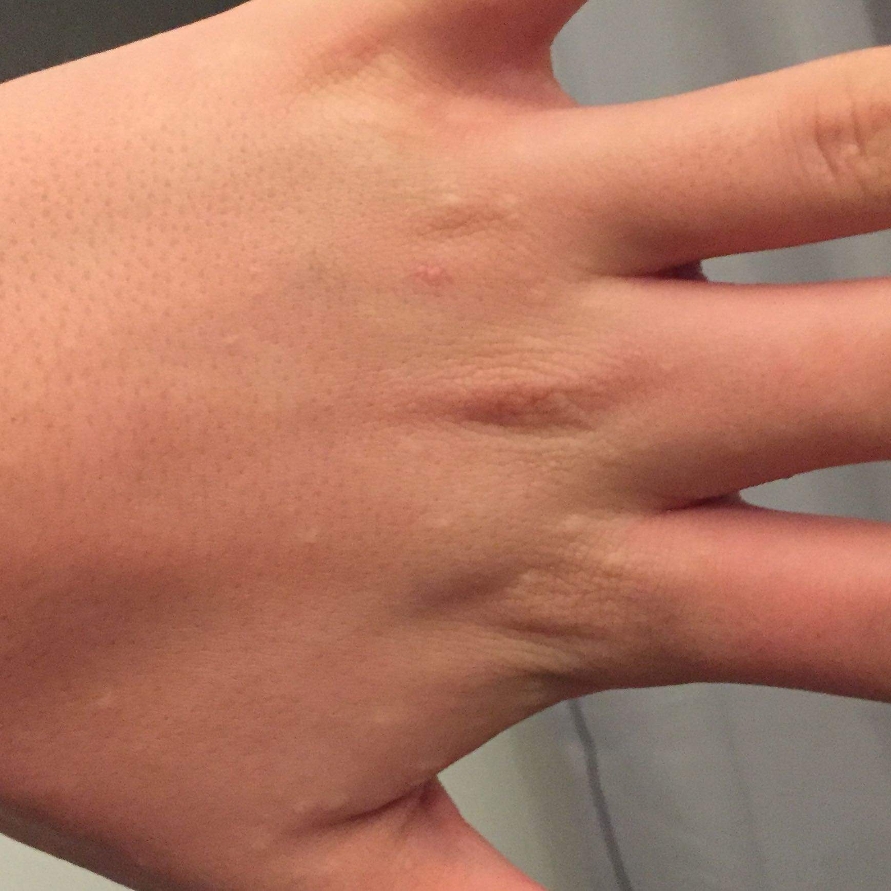 Kratze Behandlung Kratze Behandlung