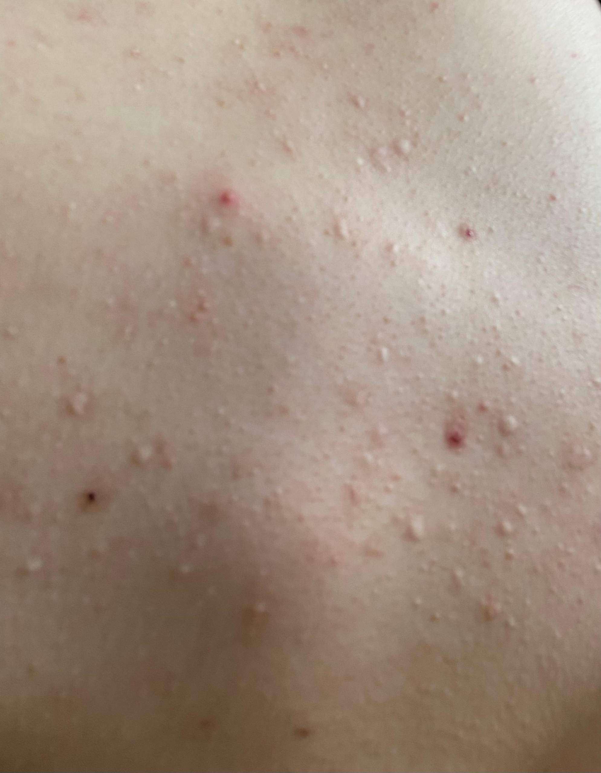 Pickel-Narben am Rücken entfernen? (Gesundheit und Medizin, Haut)