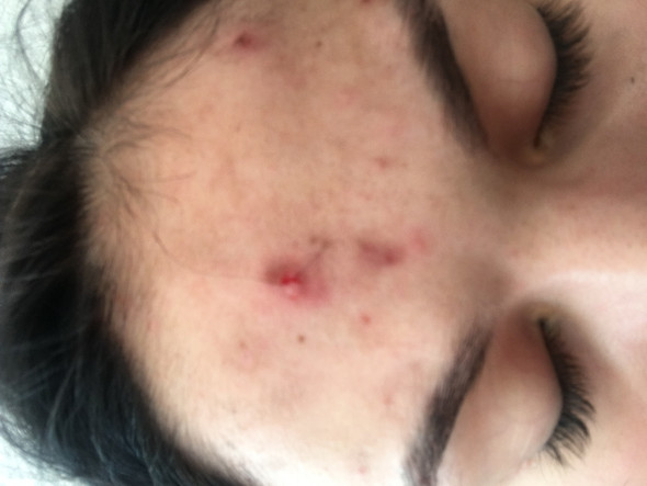 Pickel Narben Entzundung Beauty