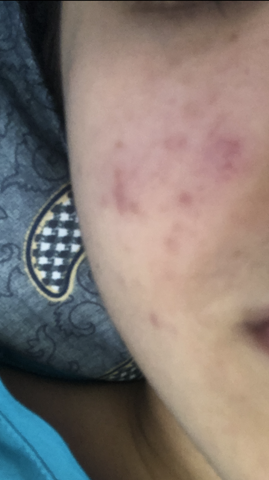 Pickel Neben Der Nase Was Tun Haut Pickel Neben Der Nase Was Tun Haut