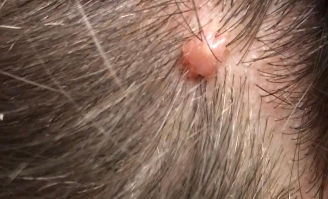 pickel auf der kopfhaut ursachen pickel auf der kopfhaut ursachen