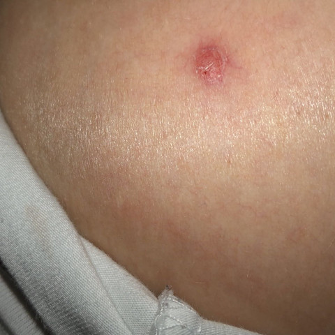 Pickel Oder Sowas Ahnliches An Der Brust Was Ist Das Gesundheit Und Medizin Medizin Pickel Oder Sowas Ahnliches An Der Brust Was Ist Das Gesundheit Und Medizin Medizin