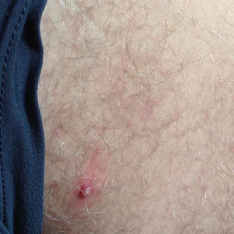 Pickel Oder Was Ist Das Bitte Hilfe Medizin Menschen Manner Pickel Oder Was Ist Das Bitte Hilfe Medizin Menschen Manner