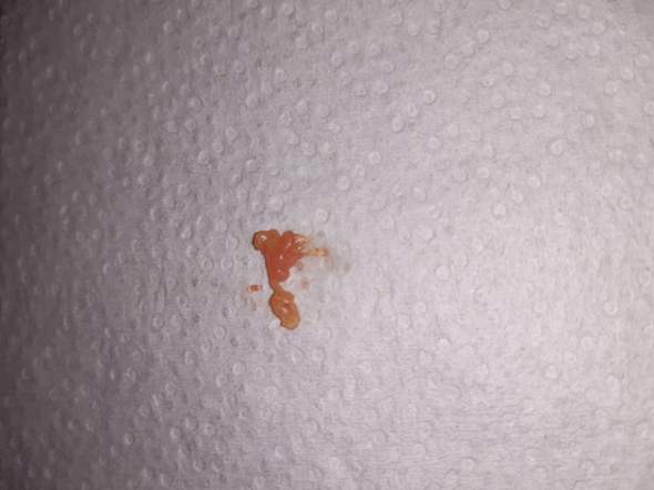 Pickel Ohne Eiter Aber Was Anderes Kam Raus Was Ist Das Gesundheit Und Medizin Gesundheit Kinder Pickel Ohne Eiter Aber Was Anderes Kam Raus Was Ist Das Gesundheit Und Medizin Gesundheit Kinder