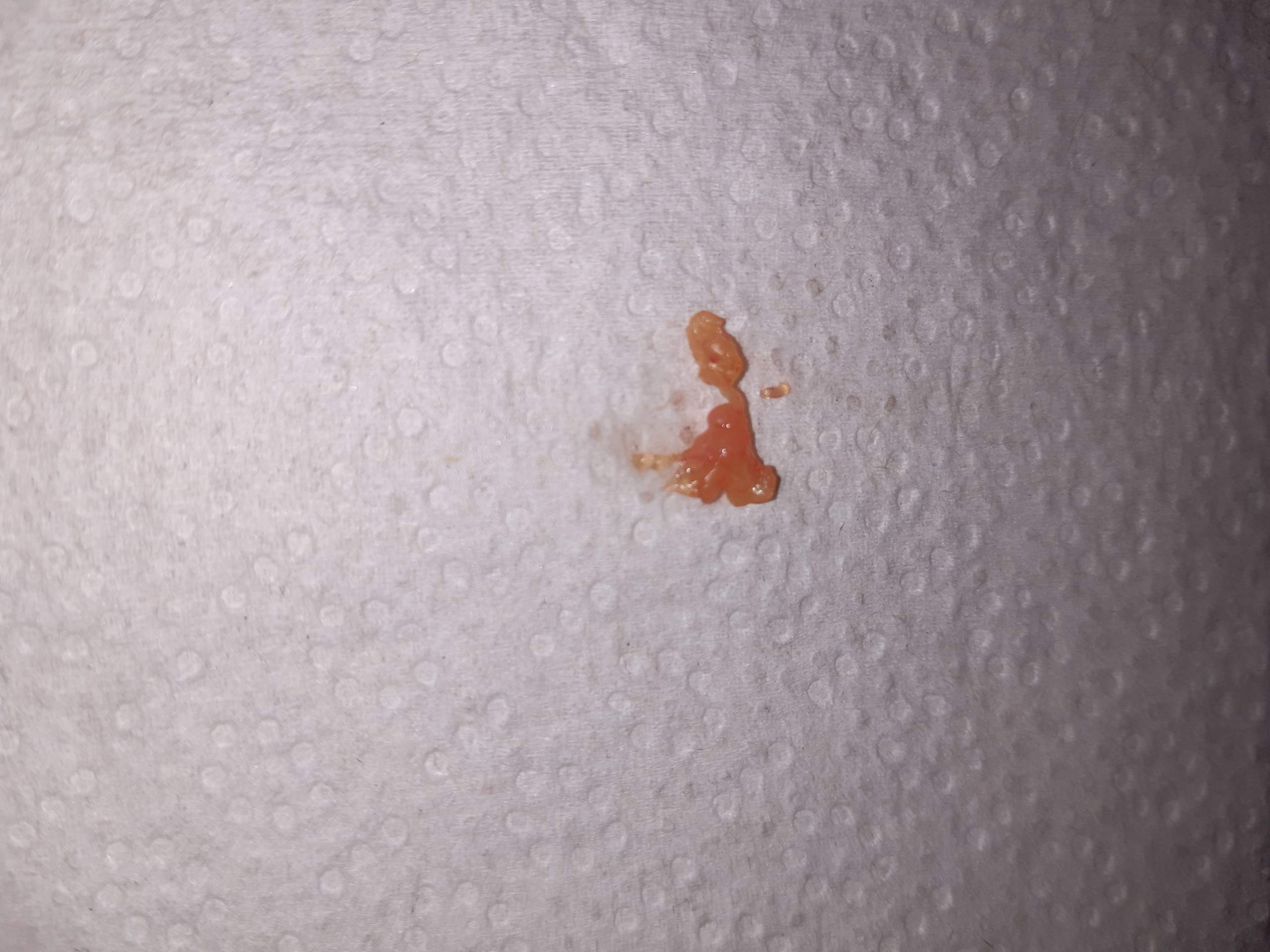 Pickel ohne Eiter aber was anderes kam raus was ist das? (Gesundheit und Medizin, Gesundheit