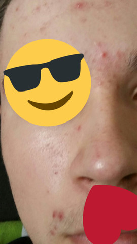 Pickel sind nur am Gesicht - (Pickel)