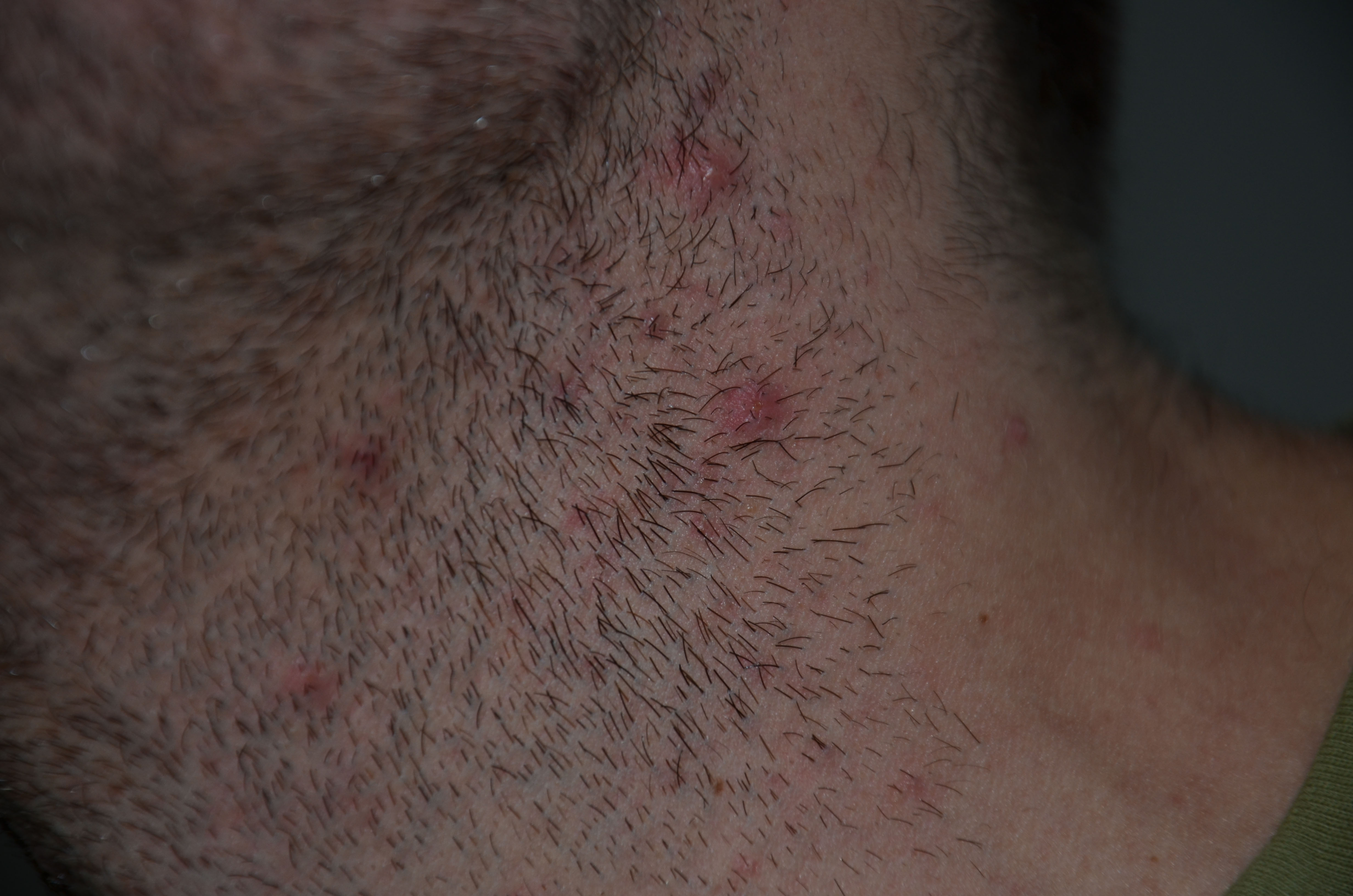 Pickel, Pusteln und Entzündungen! Hautprobleme im Halsbereich durch Rasur? (Entzündung) pickel am hals seitlich