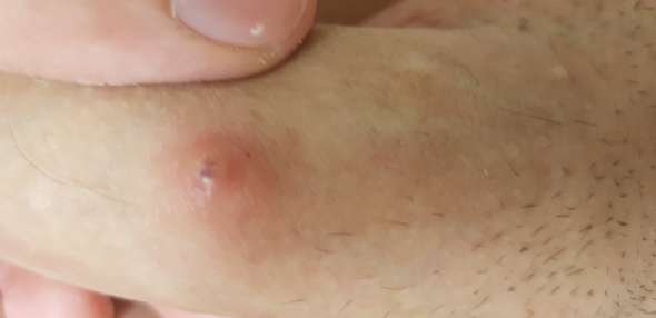 Pickel Regelmassig Am Linken Penisschaft Gesundheit Und Medizin Pickelmale Pickel Regelmassig Am Linken Penisschaft Gesundheit Und Medizin Pickelmale