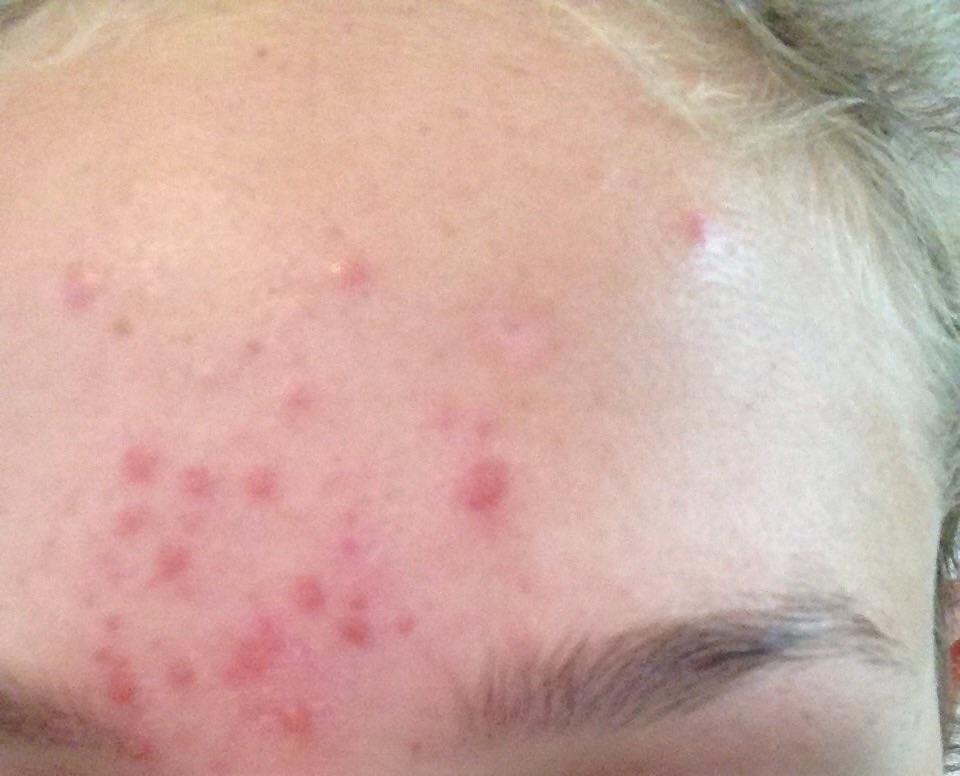 Pickel Rötung und Entzündung lindern pickel entzündung