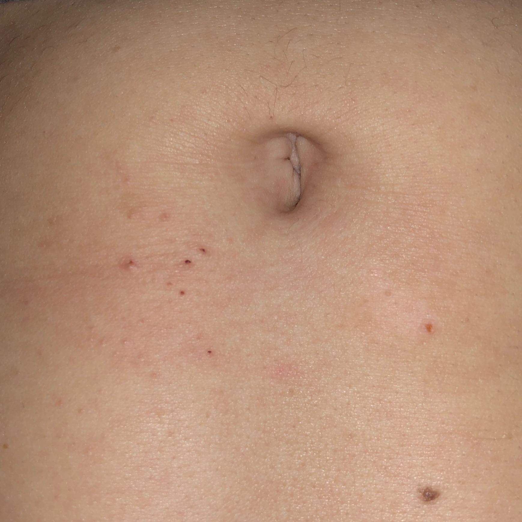 Pickel um den bauchnabel was tun? (Gesundheit und Medizin, Tattoo