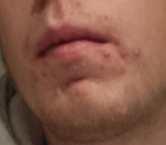 Pickel Um Den Mund Bitte Helft Mir Haut Pickel Um Den Mund Bitte Helft Mir Haut