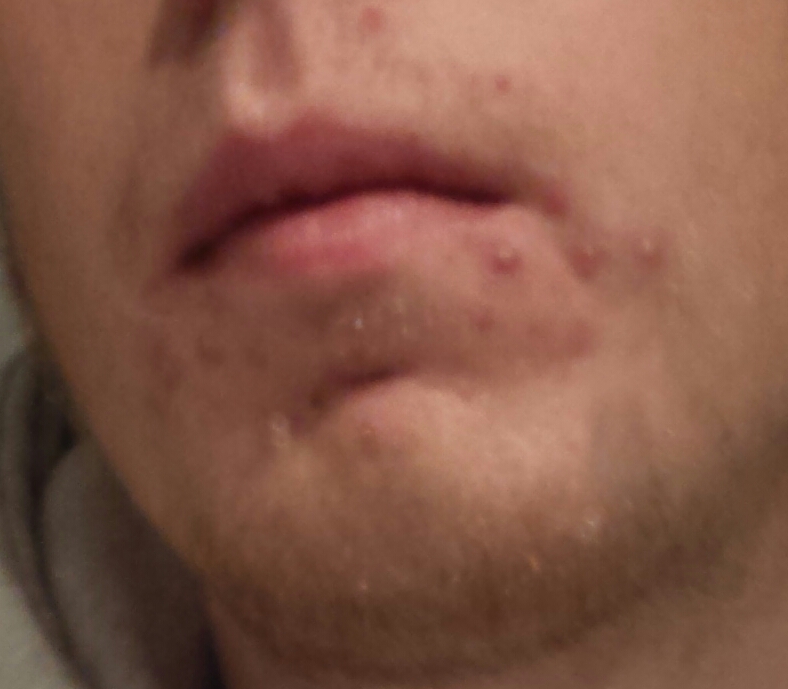 49+ Pickel Im Mund Images