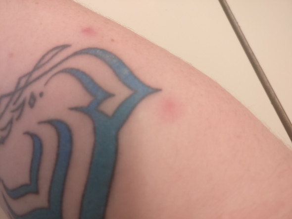 Pickel Um Neues Tattoo