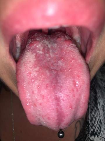 Download Pickel Auf Der Zunge Kind Pics