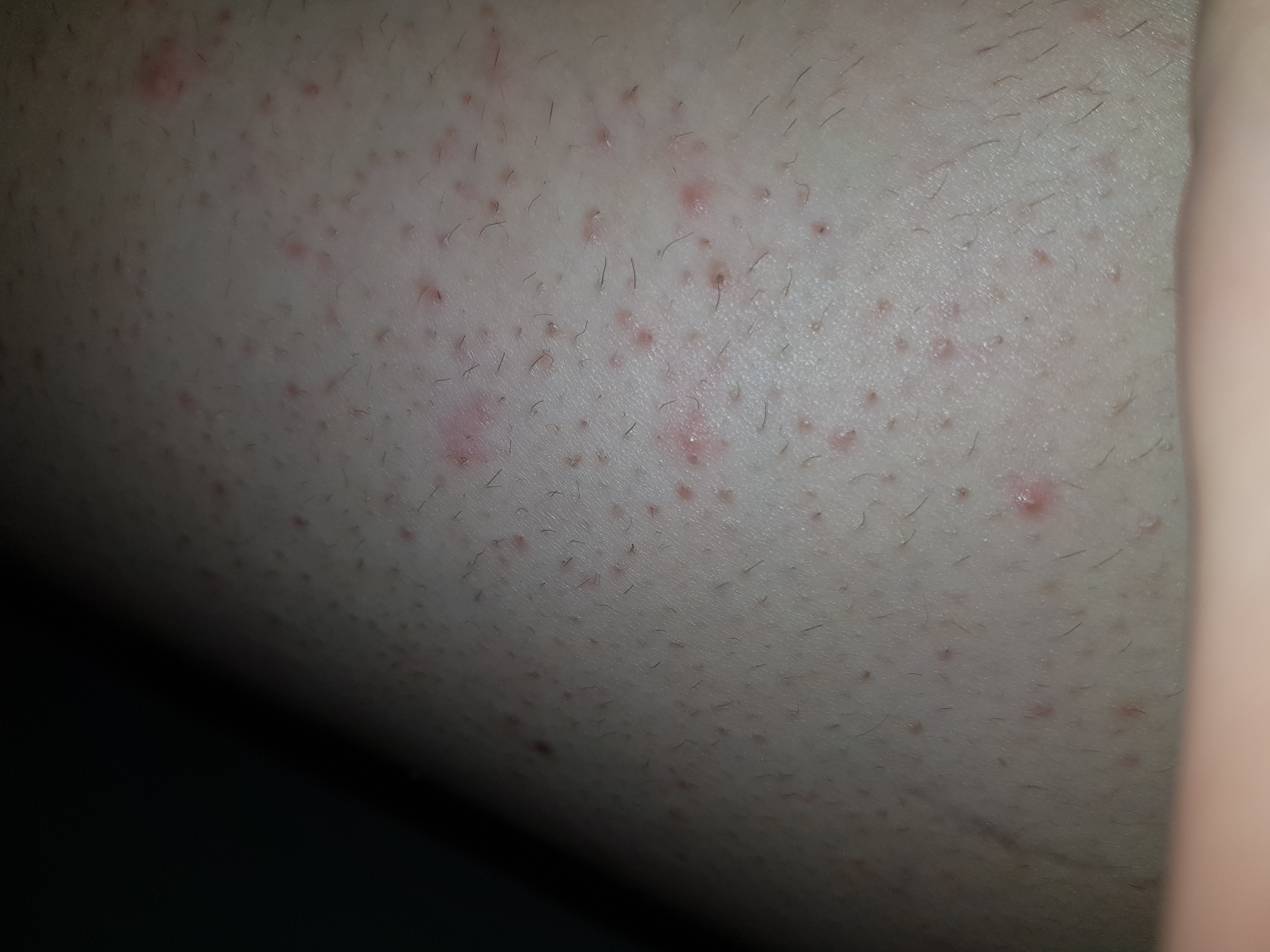 pickel und eingewachsene haare an den