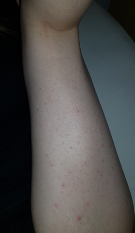 pickel und eingewachsene haare an den