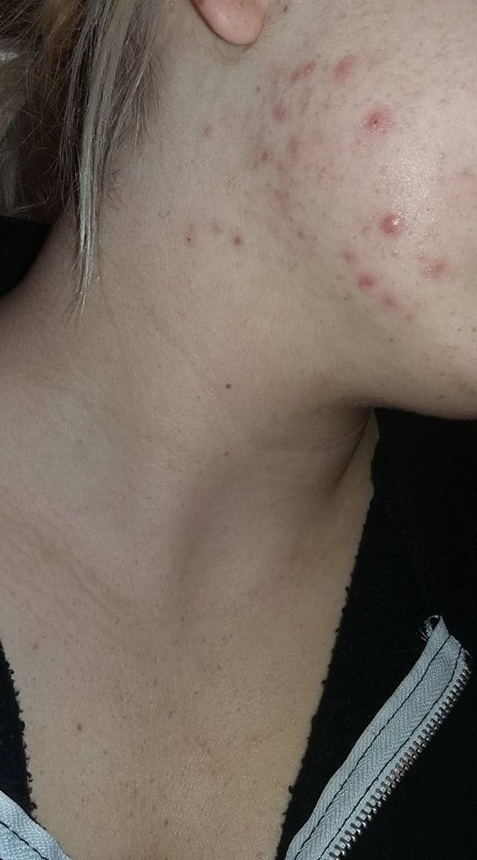 pickel an der wange ursache