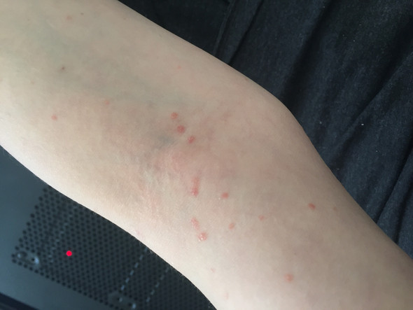 Pickel Unter Den Achseln Und Auf Der Haut Pickel Unter Den Achseln Und Auf Der Haut