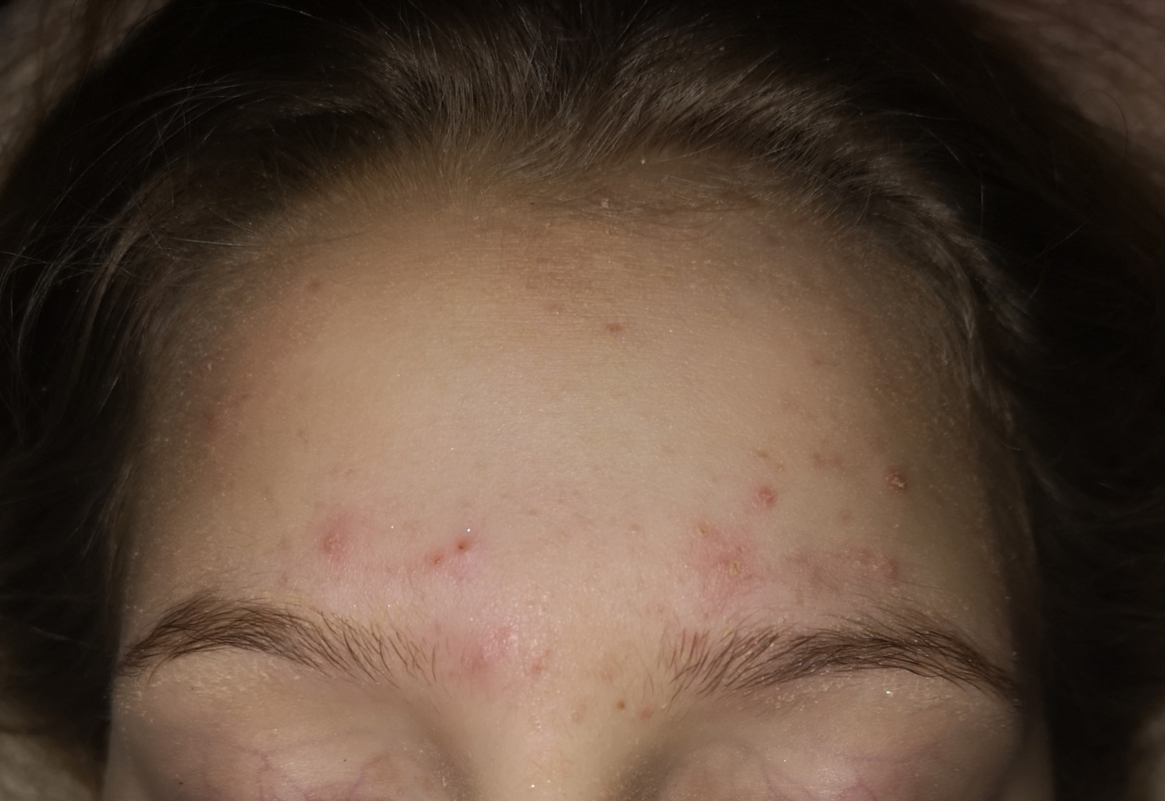 Pickel von Pille? (Haut, Teenager, Hormone) pickel am hals hormone