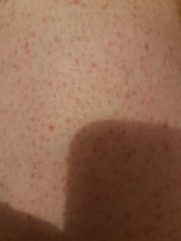 - (Gesundheit und Medizin, Haut, Pickel)