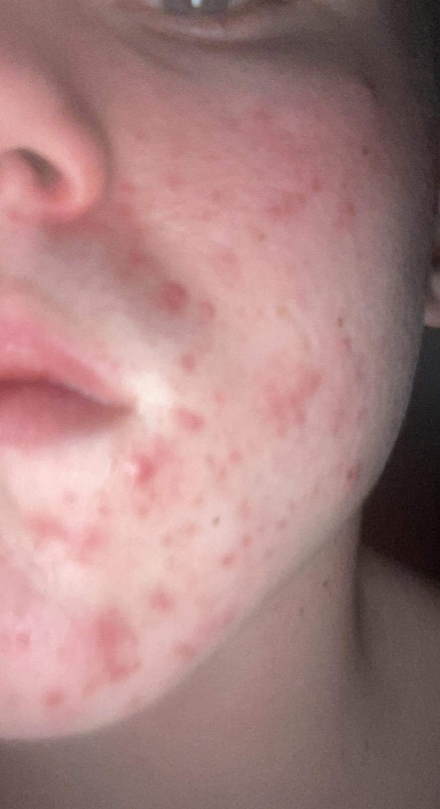 pickel an schultern wegbekommen pickel an schultern wegbekommen