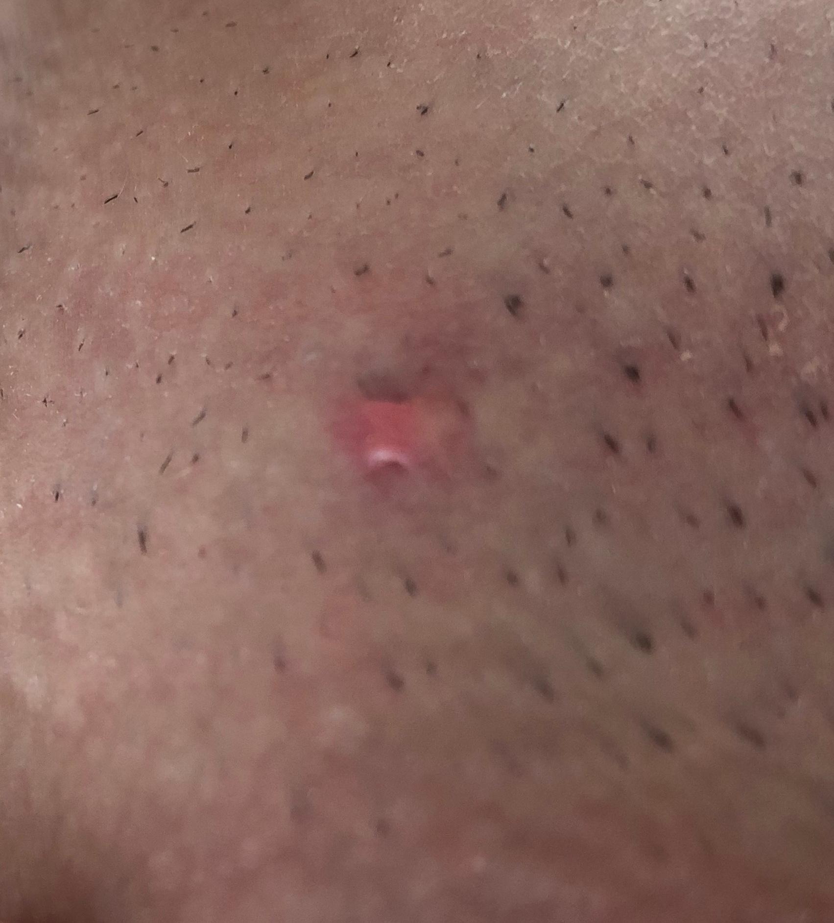 pickel zwischen hoden und oberschenkel