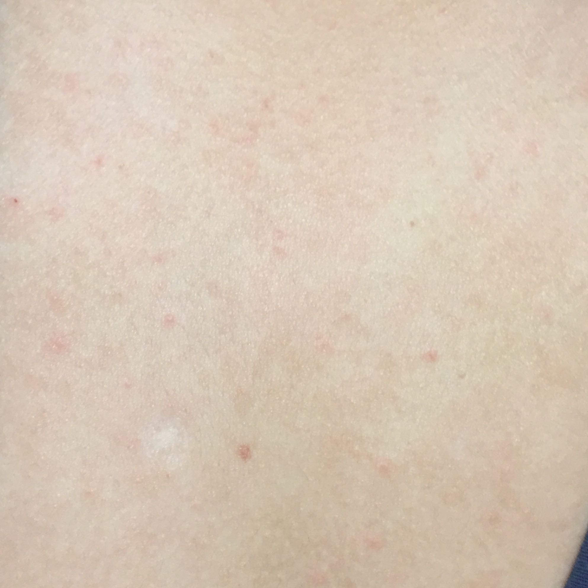 Pickelähnliche Unreinheiten auf Rücken/brust/arm? (Gesundheit und Medizin, Gesundheit, Sport und pickel auf brust und rücken