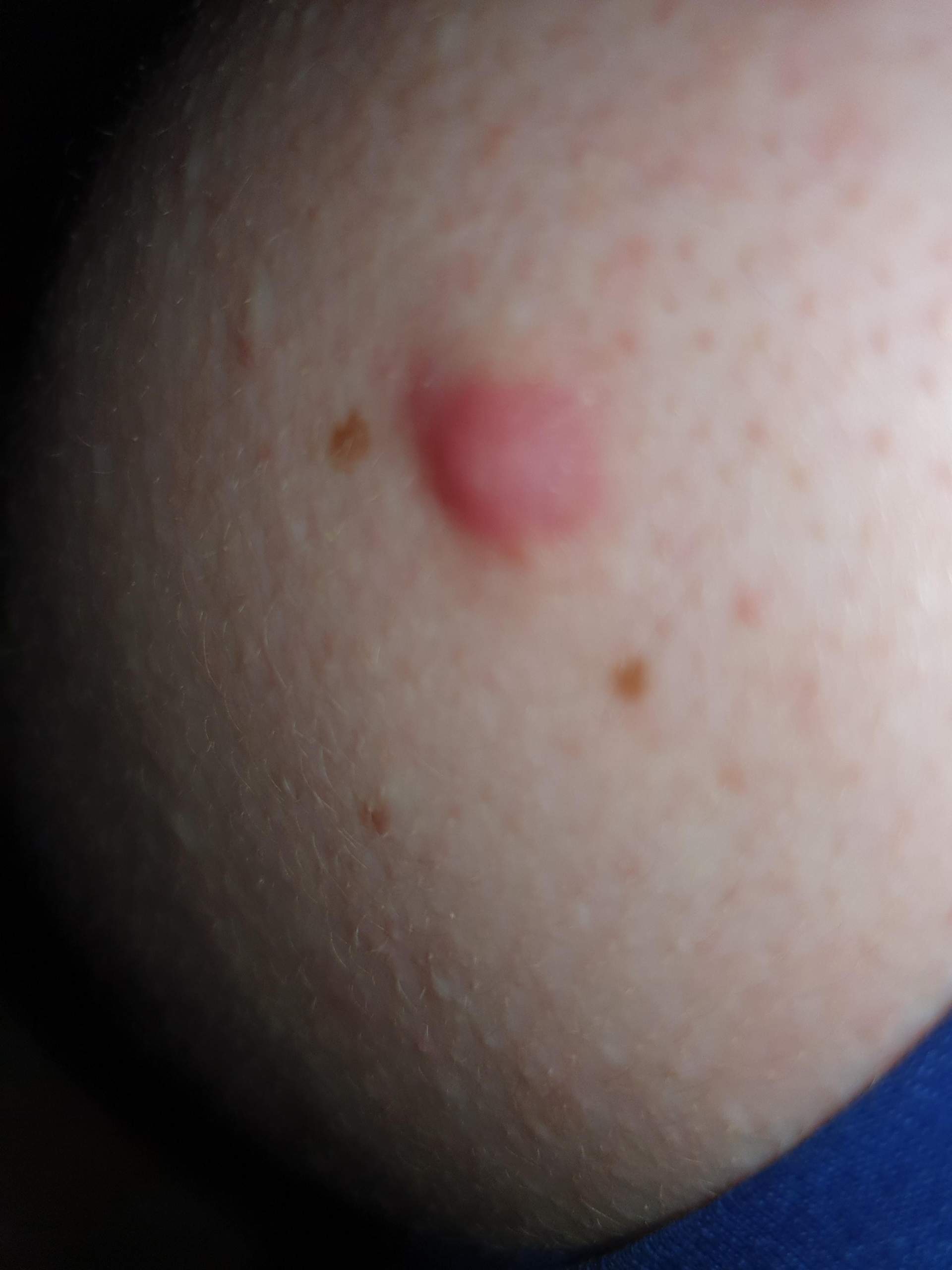 pickel an schulter pickel an schulter