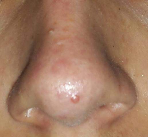 Pickelartiger Roter Punkt Auf Nase Was Ist Das Gesundheit Und Medizin Pickel Kosmetik