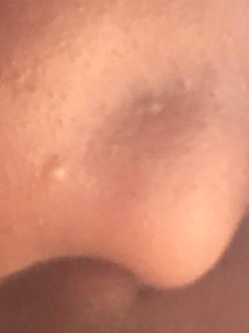 36+ Pickel An Der Lippe Was Tun Background