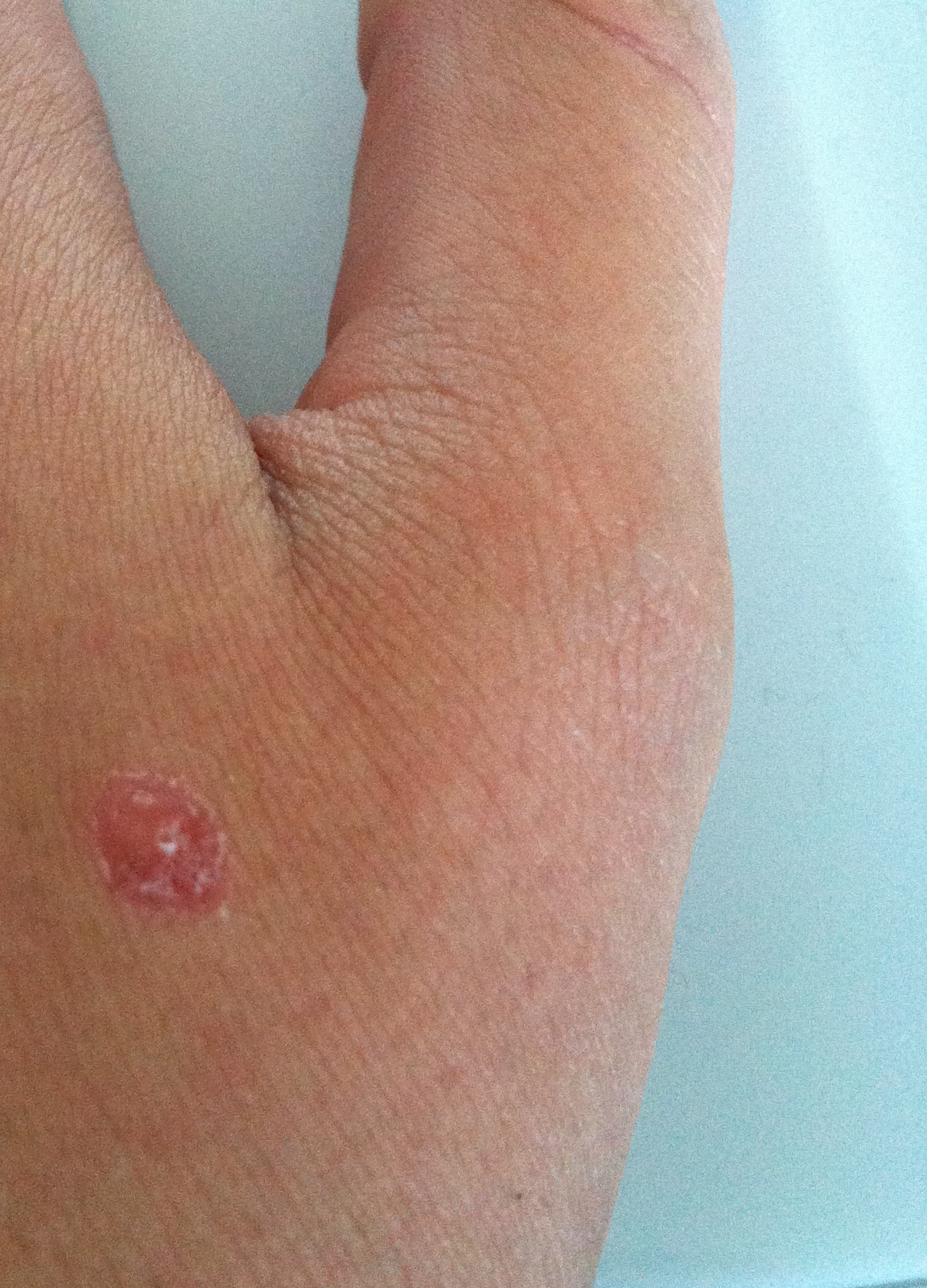 Pickelartiges Ding auf der Hand. Was ist das? (Haut, Pickel, Warzen) pickel hand