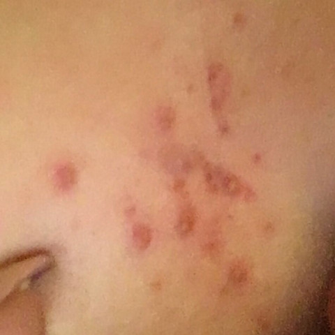 Pickel Ausschlag Zwischen Den Brusten Gesundheit Und Medizin Dekoltee