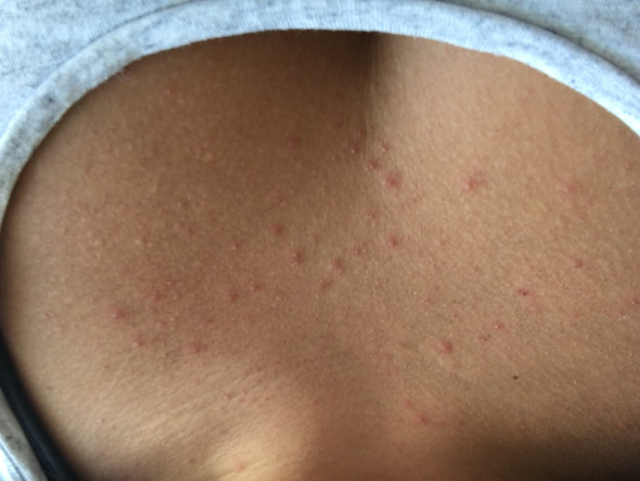 Pickelchen Am Hals Hiv Pickel