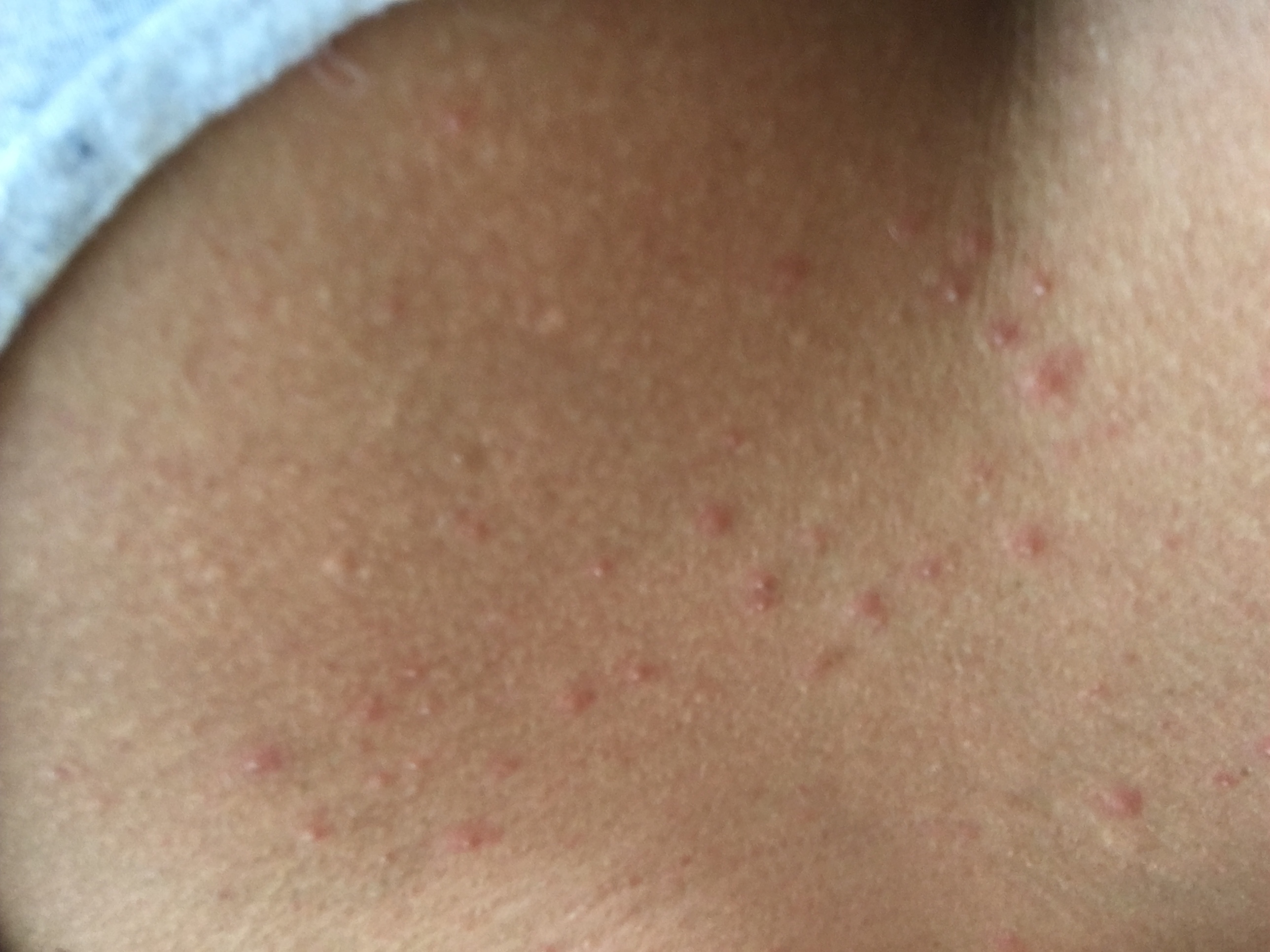 Pickelchen am Hals HIV? (Pickel)