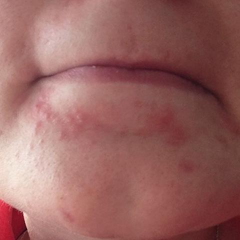 Pickelchen Am Kinn Wird Schlimmer Pickel Brennen Ausschlag Pickelchen Am Kinn Wird Schlimmer Pickel Brennen Ausschlag