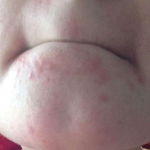 Pickelchen Am Kinn Wird Schlimmer Pickel Brennen Ausschlag