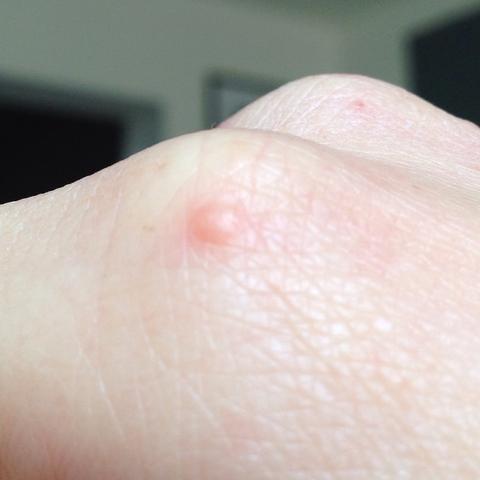 Pickelchen An Der Hand Pickel Hautprobleme Hauterkrankung Pickelchen An Der Hand Pickel Hautprobleme Hauterkrankung