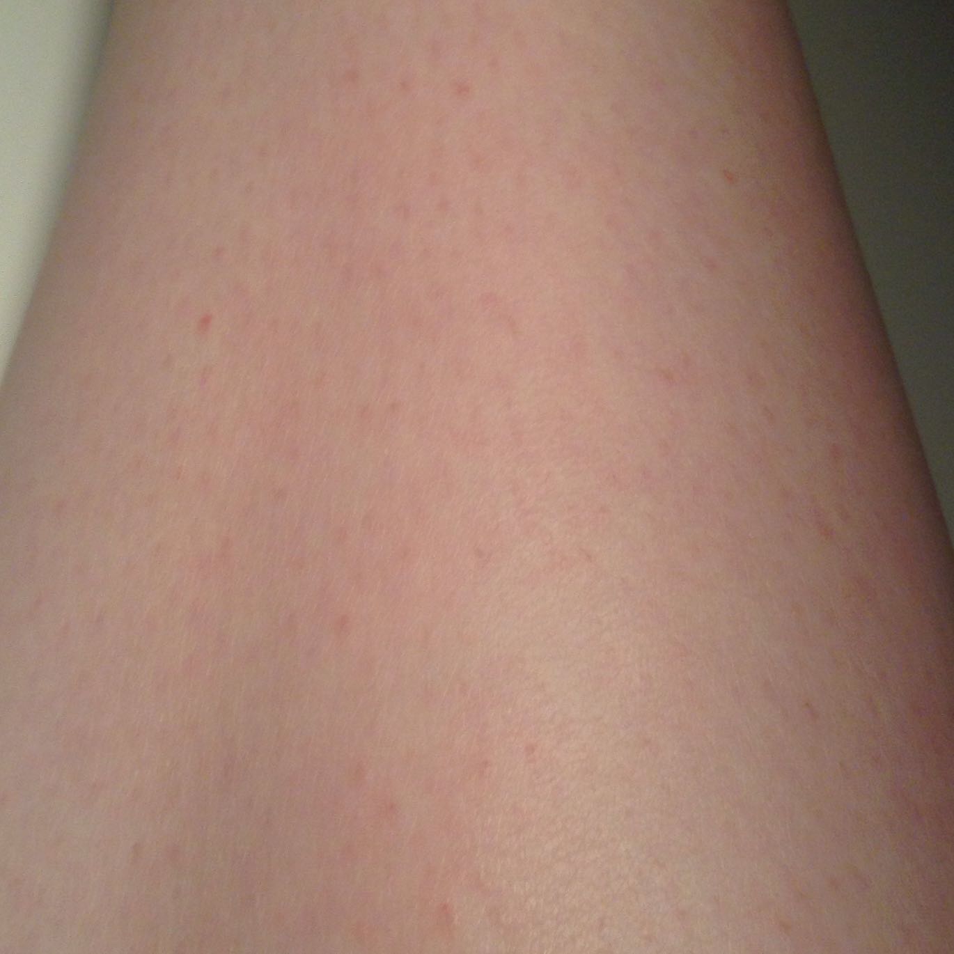 Pickelchen auf den Beinen schnell entfernen? (Sport, Beine) pickel auf beinen