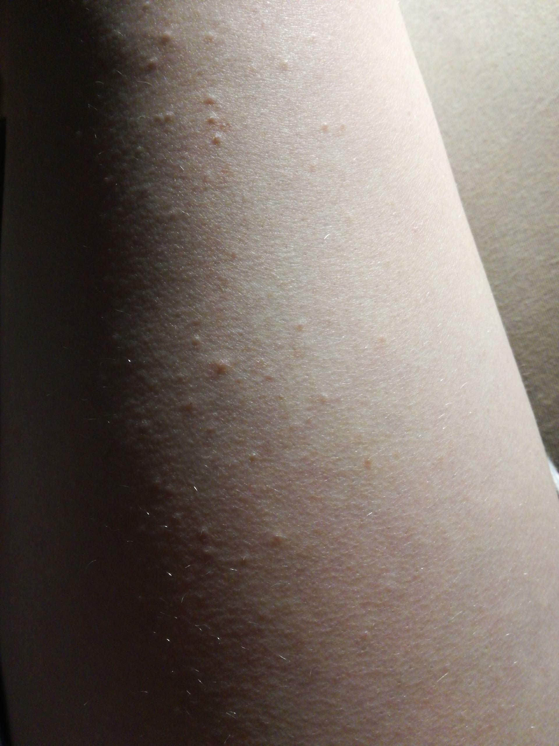 Pickelchen auf den Beinen und Armen. Was ist das und