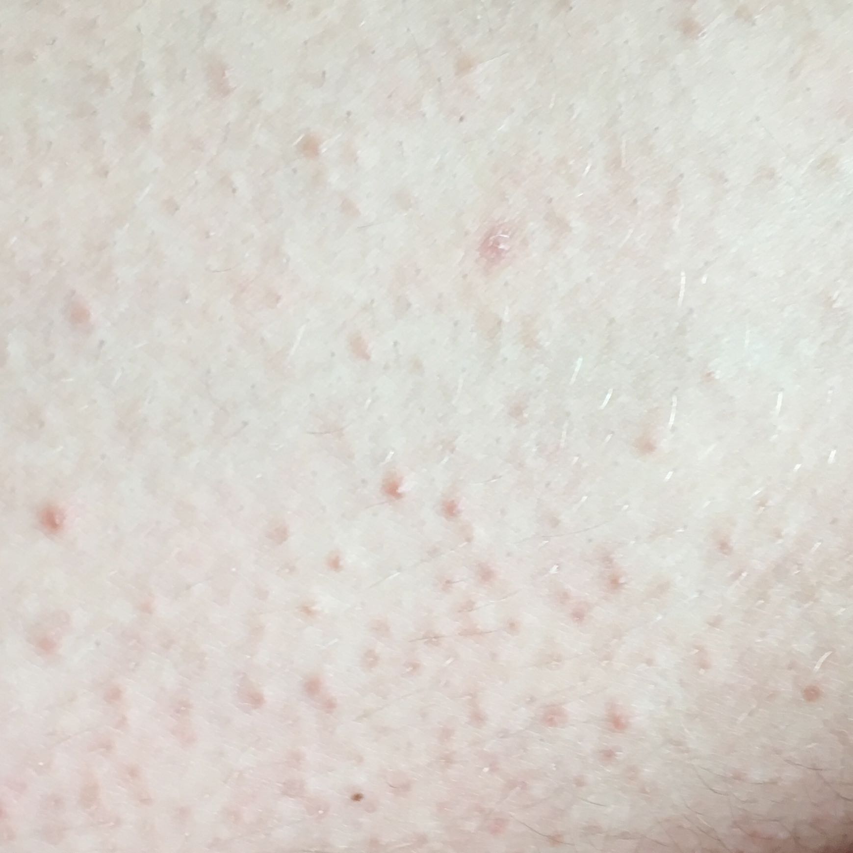 Pickelchen auf den Oberschenkeln? (Haut, Pickel) pickel an oberschenkel