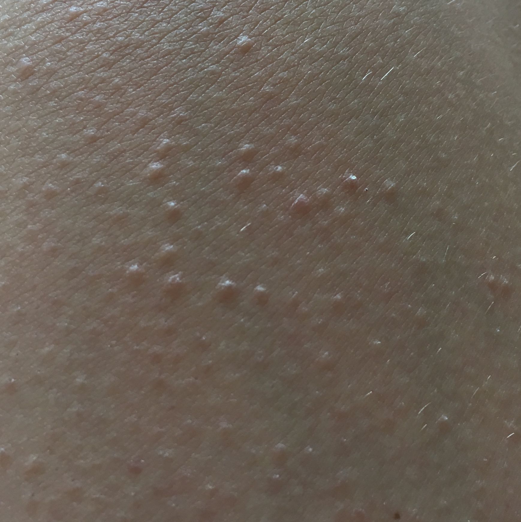 Pickelchen auf den Oberschenkeln? (Haut, Pickel) pickel auf dem oberschenkel