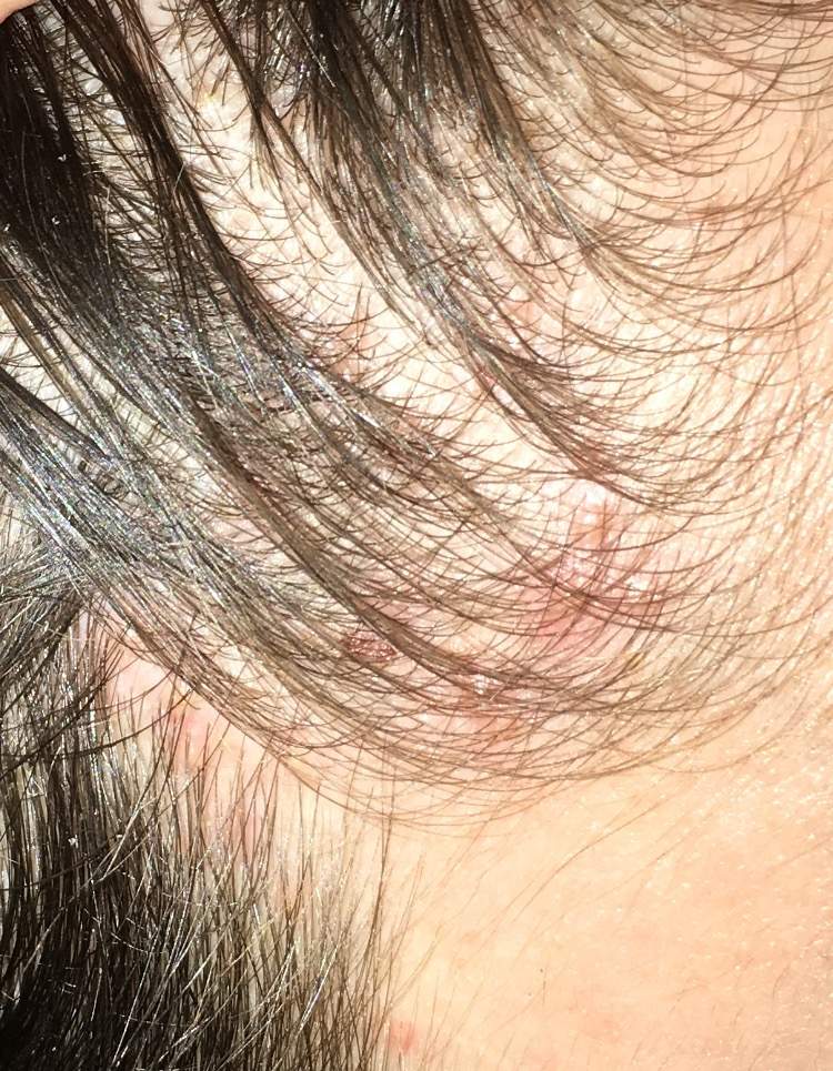 Pickelchen auf der kopfhaut? (Pickel) pickel am kopfhaut