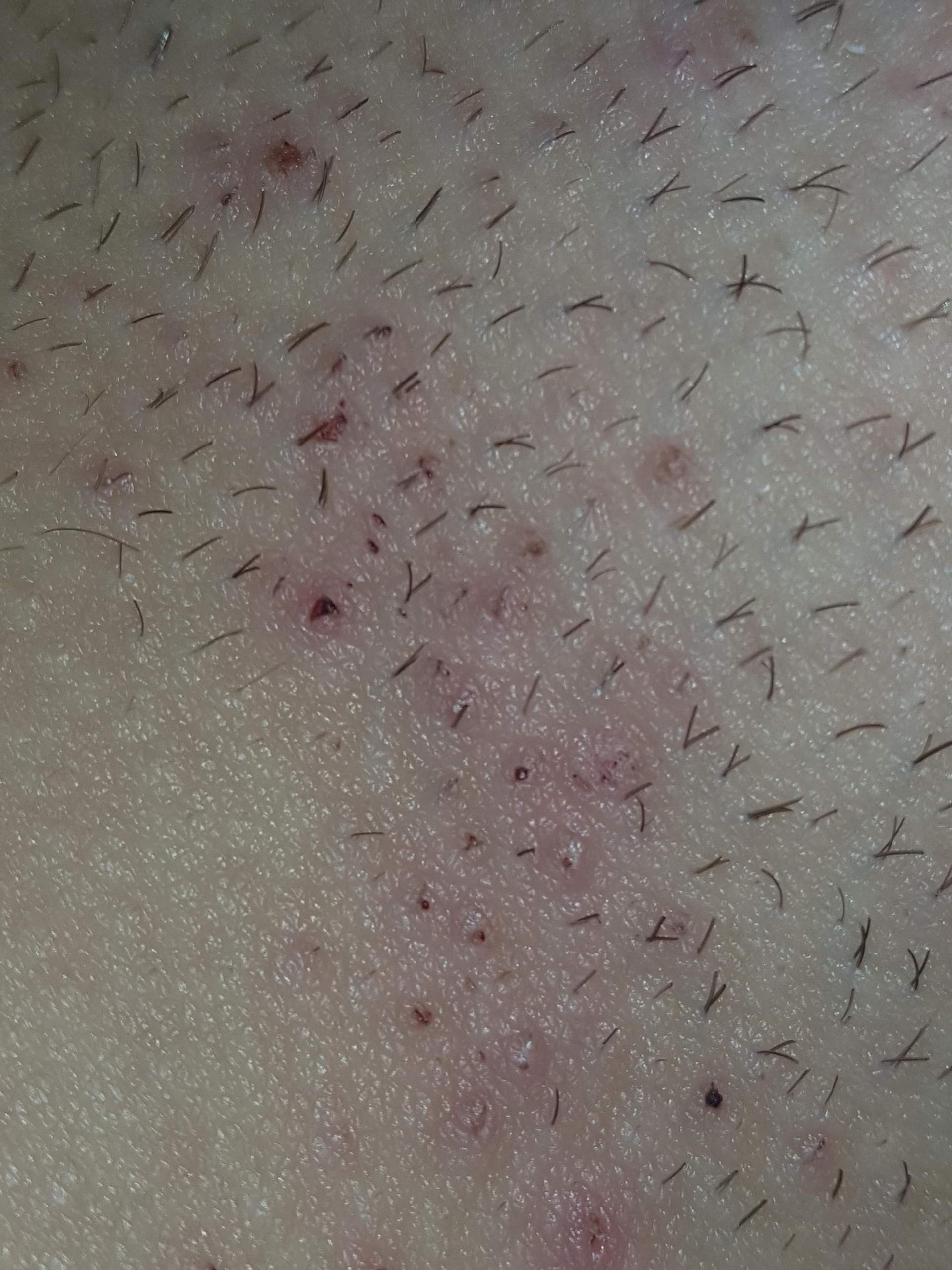 Pickel/Entzündung? (Gesundheit und Medizin, Penis, rasieren)