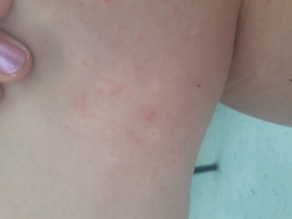 Pickel Zwischen Den Beinen - Quotes Welcome pickel auf dem oberschenkel