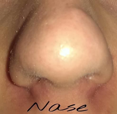 Nase - (Haut, Nase, Akne)