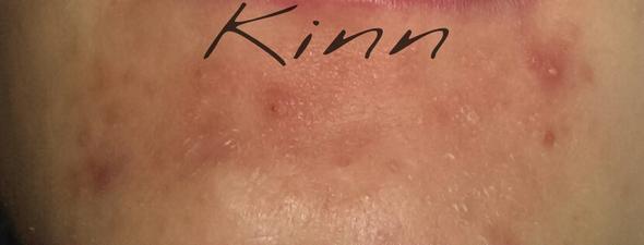 Kinn - (Haut, Nase, Akne)