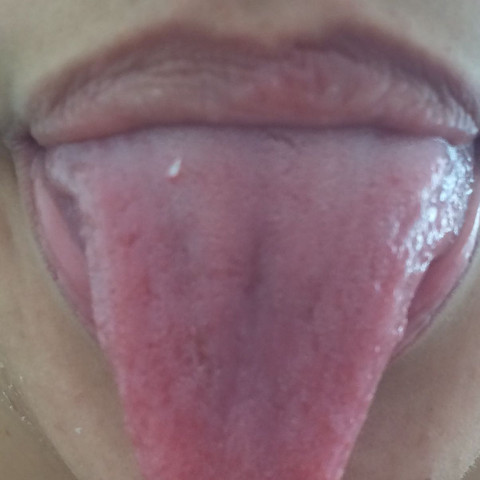 Get Pickel Auf Der Zunge Hinten Corona Gif